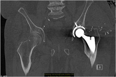 Radiological Imaging Evaluation of the Failing Total Hip Replacement